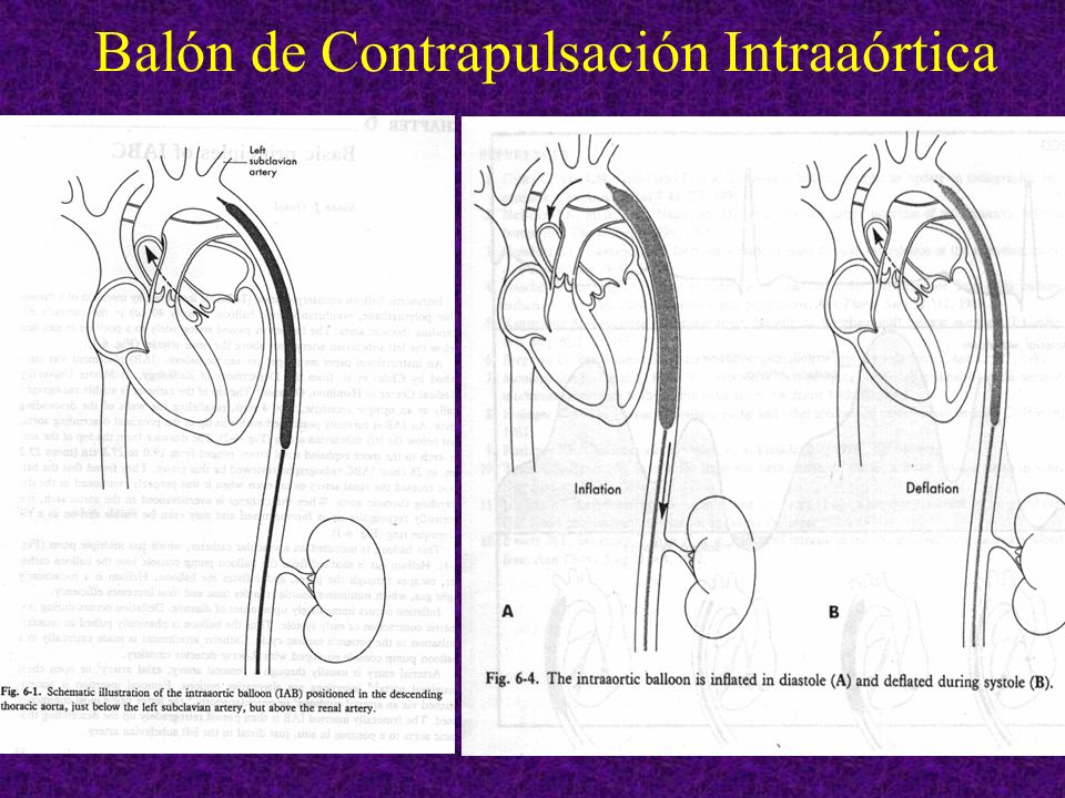 balon contrapulsacion